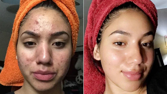 Teen shares how she cleared her severe acne  using a one-ingredient product