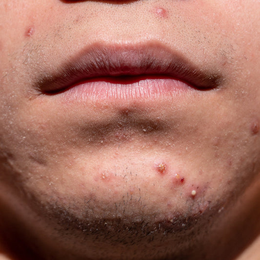 Man caring for skin prone to acne on the face and back