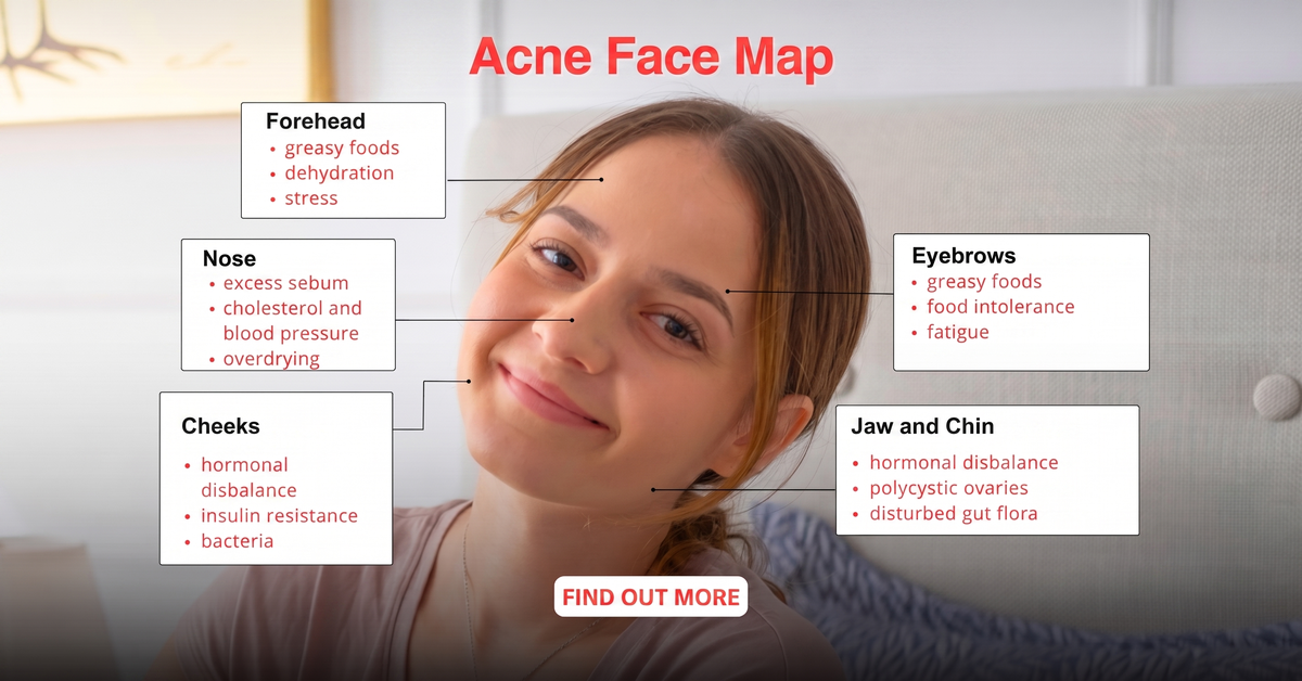 Acne face map showing breakout zones on the face